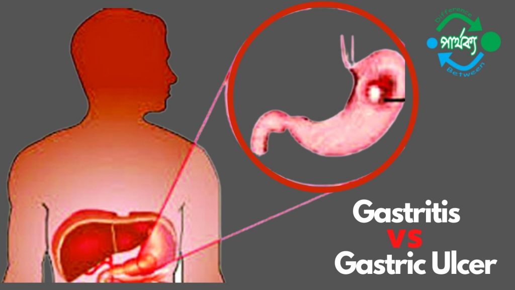গ্যাসট্রাইটিস ও গ্যাস্ট্রিক আলসারের
