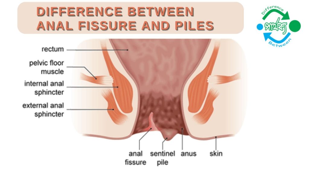 এনাল ফিসার ও পাইলস